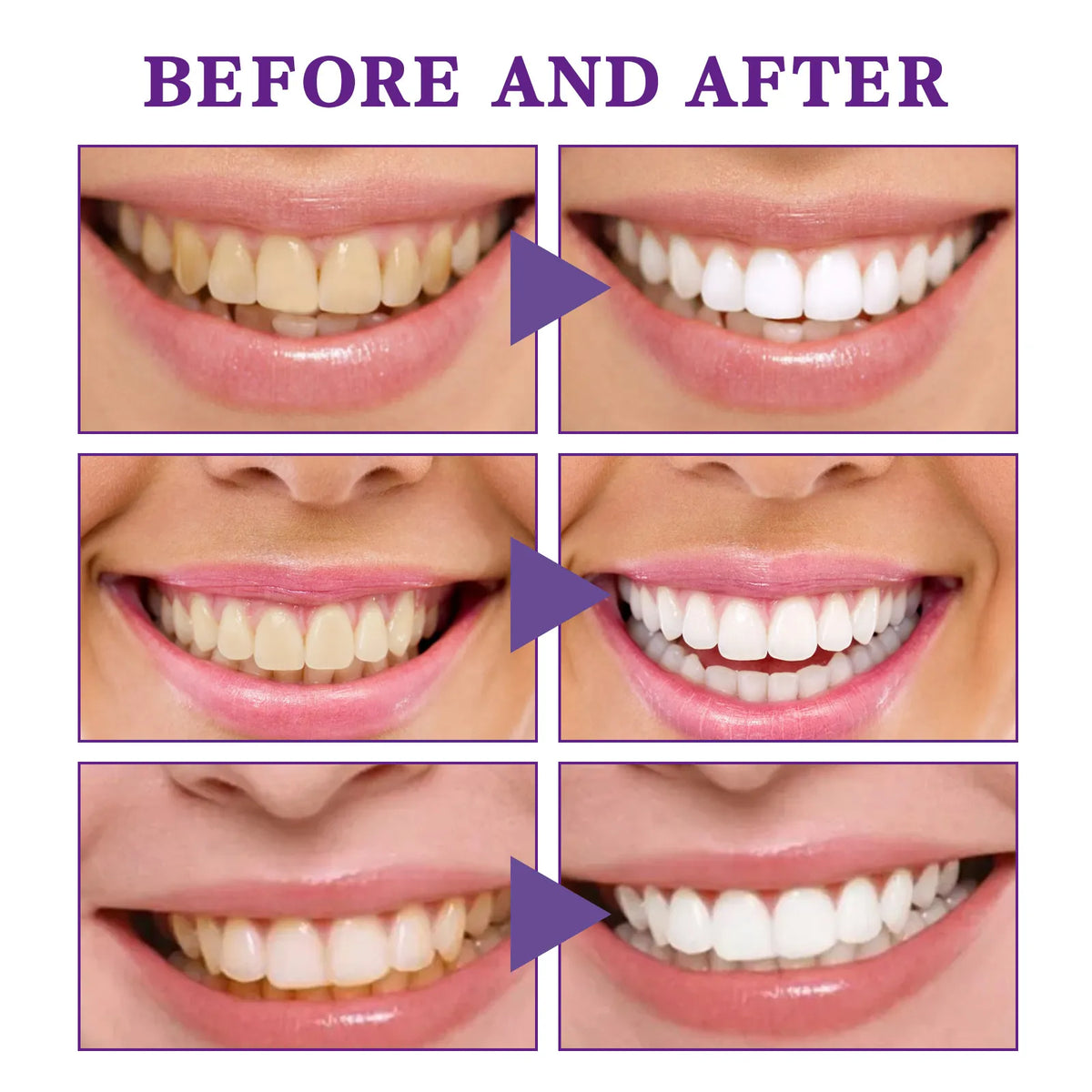 V34 Teeth Whitening Mousse – Stain Removal & Gum Care